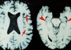 Brain disease in dead NFL players 'higher than previously shown'