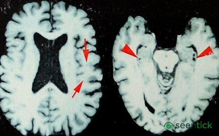 Brain disease in dead NFL players 'higher than previously shown'