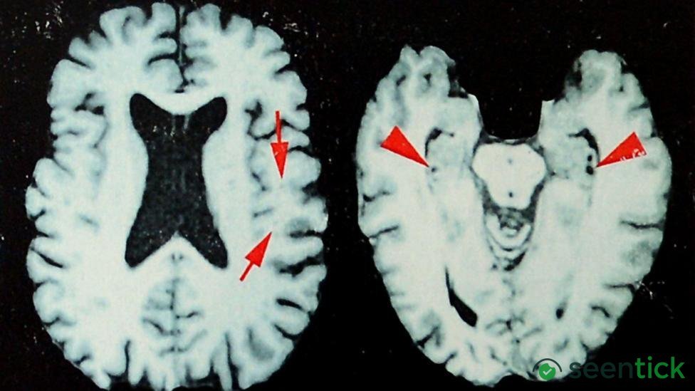 Brain disease in dead NFL players 'higher than previously shown'