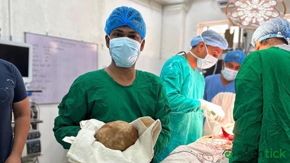 Doctors remove 3.1kg stone from man's bladder and claim record