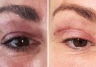'My eyelids became infected - I was scared to sleep'