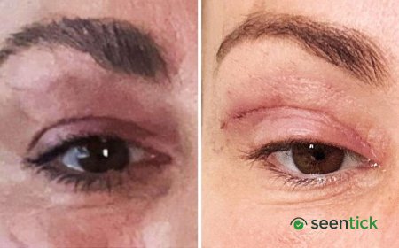 'My eyelids became infected - I was scared to sleep'
