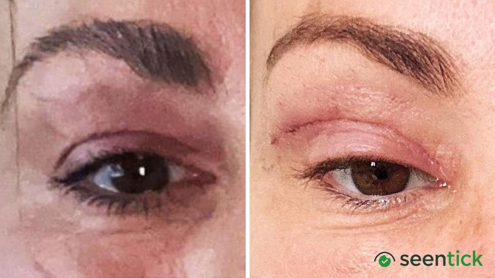 'My eyelids became infected - I was scared to sleep'