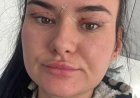 Open wounds and eyes that can't close - women warn about cheap bleph eyelid surgery