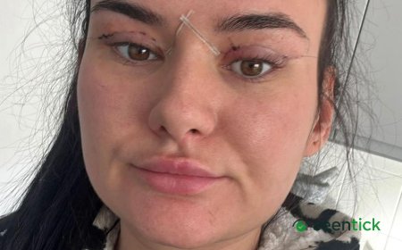 Open wounds and eyes that can't close - women warn about cheap bleph eyelid surgery