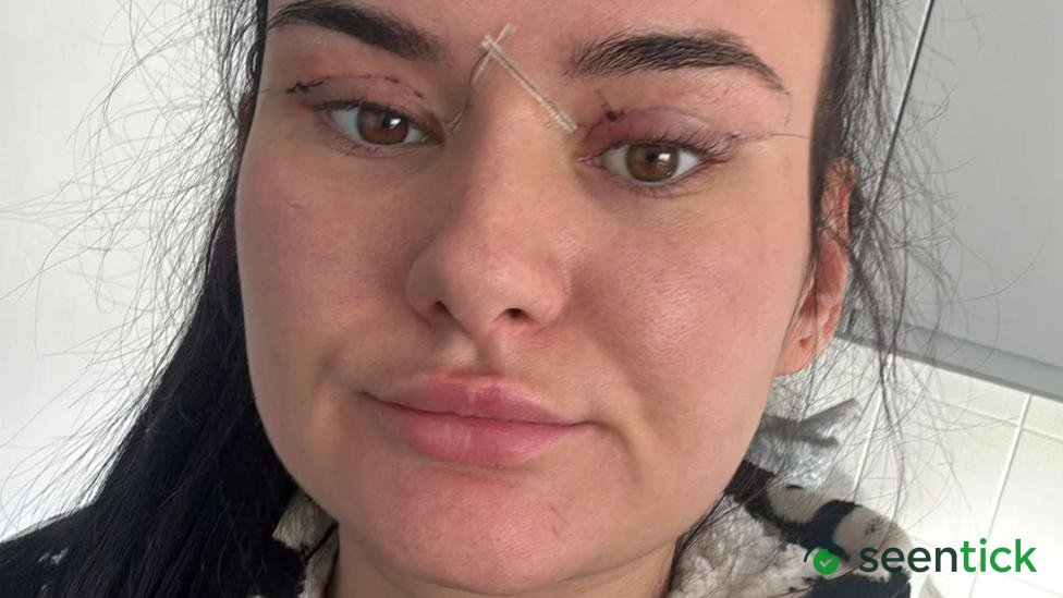 Open wounds and eyes that can't close - women warn about cheap bleph eyelid surgery