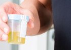 Urine test can spot more than nine in 10 bladder cancers