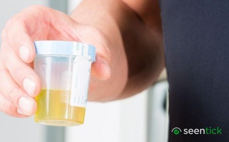 Urine test can spot more than nine in 10 bladder cancers