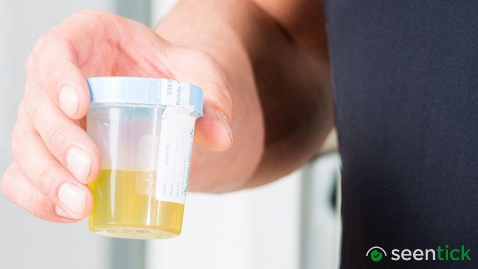 Urine test can spot more than nine in 10 bladder cancers
